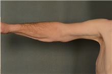 Arm Lift After Photo by Ellen Janetzke, MD; Bloomfield Hills, MI - Case 42992