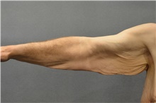 Arm Lift Before Photo by Ellen Janetzke, MD; Bloomfield Hills, MI - Case 42992
