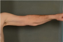 Arm Lift After Photo by Ellen Janetzke, MD; Bloomfield Hills, MI - Case 42992
