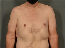 Male Breast Reduction After Photo by Ellen Janetzke, MD; Bloomfield Hills, MI - Case 42994