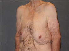 Male Breast Reduction Before Photo by Ellen Janetzke, MD; Bloomfield Hills, MI - Case 42994