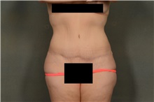 Tummy Tuck After Photo by Ellen Janetzke, MD; Bloomfield Hills, MI - Case 43186
