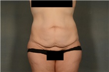 Tummy Tuck Before Photo by Ellen Janetzke, MD; Bloomfield Hills, MI - Case 43186
