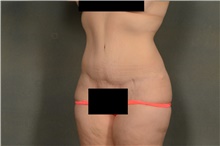 Tummy Tuck After Photo by Ellen Janetzke, MD; Bloomfield Hills, MI - Case 43186