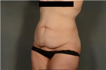Tummy Tuck Before Photo by Ellen Janetzke, MD; Bloomfield Hills, MI - Case 43186