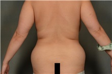 Liposuction Before Photo by Ellen Janetzke, MD; Bloomfield Hills, MI - Case 44087