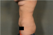 Liposuction After Photo by Ellen Janetzke, MD; Bloomfield Hills, MI - Case 44087