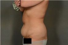 Liposuction Before Photo by Ellen Janetzke, MD; Bloomfield Hills, MI - Case 44087