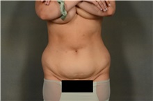 Liposuction Before Photo by Ellen Janetzke, MD; Bloomfield Hills, MI - Case 44089