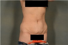 Liposuction After Photo by Ellen Janetzke, MD; Bloomfield Hills, MI - Case 44089