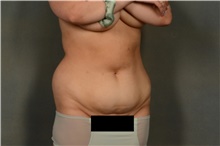 Liposuction Before Photo by Ellen Janetzke, MD; Bloomfield Hills, MI - Case 44089