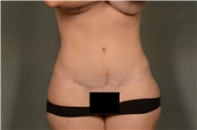 Tummy Tuck After Photo by Ellen Janetzke, MD; Bloomfield Hills, MI - Case 44090