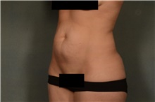 Tummy Tuck Before Photo by Ellen Janetzke, MD; Bloomfield Hills, MI - Case 44090