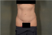 Tummy Tuck After Photo by Ellen Janetzke, MD; Bloomfield Hills, MI - Case 44091
