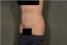 Tummy Tuck After Photo by Ellen Janetzke, MD; Bloomfield Hills, MI - Case 44091