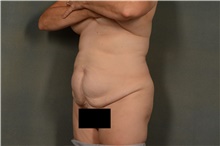 Tummy Tuck Before Photo by Ellen Janetzke, MD; Bloomfield Hills, MI - Case 44091