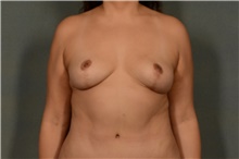 Breast Lift After Photo by Ellen Janetzke, MD; Bloomfield Hills, MI - Case 44092