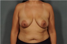 Breast Lift Before Photo by Ellen Janetzke, MD; Bloomfield Hills, MI - Case 44092