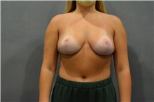 Breast Reduction After Photo by Ellen Janetzke, MD; Bloomfield Hills, MI - Case 44646