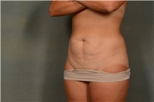Tummy Tuck Before Photo by Ellen Janetzke, MD; Bloomfield Hills, MI - Case 44648
