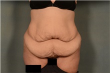 Tummy Tuck Before Photo by Ellen Janetzke, MD; Bloomfield Hills, MI - Case 44649