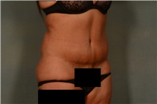 Tummy Tuck After Photo by Ellen Janetzke, MD; Bloomfield Hills, MI - Case 44649