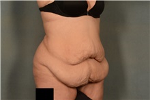 Tummy Tuck Before Photo by Ellen Janetzke, MD; Bloomfield Hills, MI - Case 44649