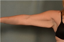 Arm Lift Before Photo by Ellen Janetzke, MD; Bloomfield Hills, MI - Case 44650