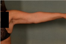 Arm Lift After Photo by Ellen Janetzke, MD; Bloomfield Hills, MI - Case 44650