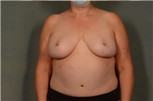 Breast Reduction After Photo by Ellen Janetzke, MD; Bloomfield Hills, MI - Case 44714
