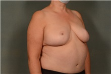Breast Reduction After Photo by Ellen Janetzke, MD; Bloomfield Hills, MI - Case 44714