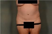 Tummy Tuck After Photo by Ellen Janetzke, MD; Bloomfield Hills, MI - Case 44715
