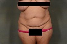 Tummy Tuck Before Photo by Ellen Janetzke, MD; Bloomfield Hills, MI - Case 44715