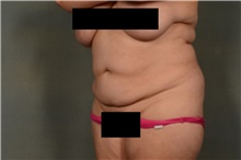 Tummy Tuck Before Photo by Ellen Janetzke, MD; Bloomfield Hills, MI - Case 44715