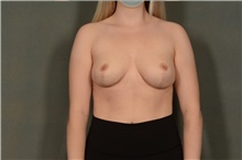 Breast Reduction After Photo by Ellen Janetzke, MD; Bloomfield Hills, MI - Case 44933