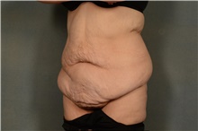 Tummy Tuck Before Photo by Ellen Janetzke, MD; Bloomfield Hills, MI - Case 45204