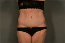 Tummy Tuck After Photo by Ellen Janetzke, MD; Bloomfield Hills, MI - Case 45205