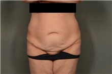 Tummy Tuck Before Photo by Ellen Janetzke, MD; Bloomfield Hills, MI - Case 45205