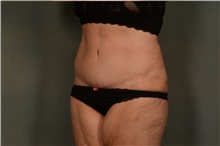 Tummy Tuck After Photo by Ellen Janetzke, MD; Bloomfield Hills, MI - Case 45205