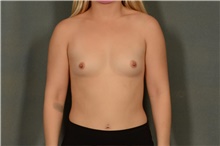 Breast Augmentation Before Photo by Ellen Janetzke, MD; Bloomfield Hills, MI - Case 45206