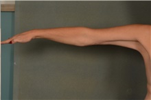 Arm Lift After Photo by Ellen Janetzke, MD; Bloomfield Hills, MI - Case 45452