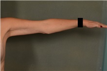 Arm Lift After Photo by Ellen Janetzke, MD; Bloomfield Hills, MI - Case 45452