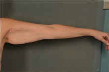 Arm Lift Before Photo by Ellen Janetzke, MD; Bloomfield Hills, MI - Case 45452