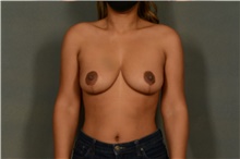 Breast Reduction After Photo by Ellen Janetzke, MD; Bloomfield Hills, MI - Case 45453