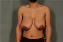 Breast Reduction Before Photo by Ellen Janetzke, MD; Bloomfield Hills, MI - Case 45453
