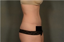 Tummy Tuck After Photo by Ellen Janetzke, MD; Bloomfield Hills, MI - Case 45454