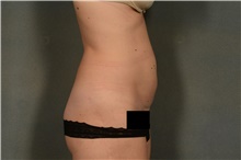 Tummy Tuck Before Photo by Ellen Janetzke, MD; Bloomfield Hills, MI - Case 45454