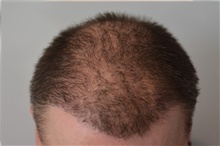 Hair Transplant After Photo by Ellen Janetzke, MD; Bloomfield Hills, MI - Case 45625