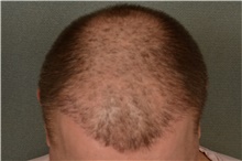 Hair Transplant Before Photo by Ellen Janetzke, MD; Bloomfield Hills, MI - Case 45625
