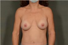 Breast Augmentation After Photo by Ellen Janetzke, MD; Bloomfield Hills, MI - Case 45626